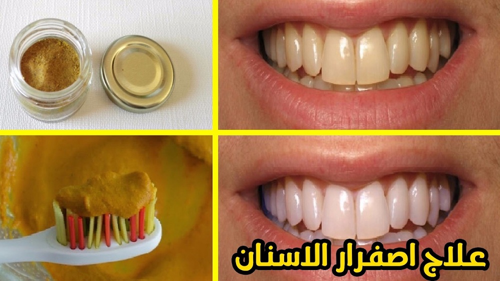 مزيج القرنفل السحري يبيض الأسنان ويزيل الإصفرار ورائحة الفم في دقائق .. إليك طريقة الاستخدام