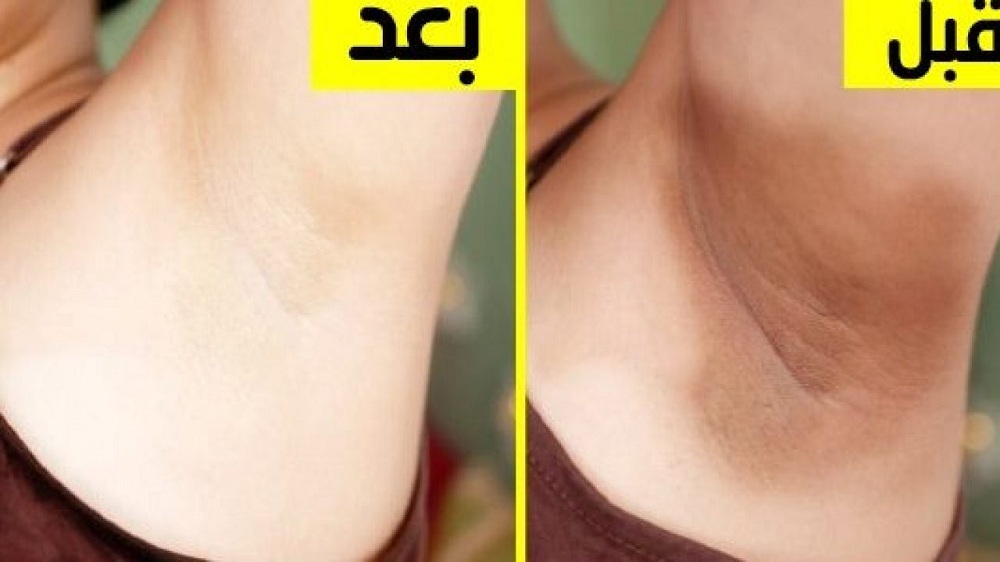 كريم جبار لتبييض المناطق الحساسة شديدة السواد بياض ملفت من أول استعمال!.. تعرف عليه