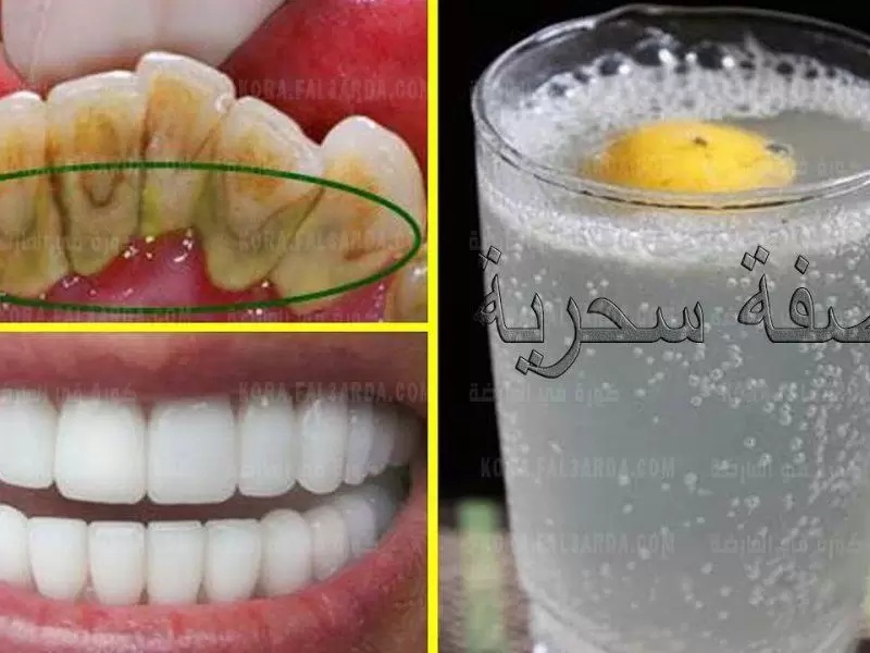 وداعاً للطبيب.. خلطة جبارة لتبيض الاسنان في المنزل بدون تسويس وبدون اصفرار أسنانك هتبقى لؤلؤ