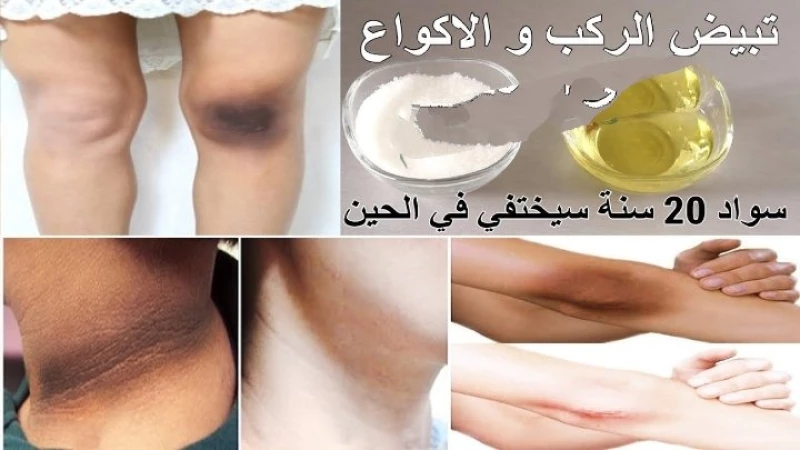 خلطة سحرية لتبييض وتقشير الركب والاكواع وإزالة البقع الغامقة من أول أستخدام.. طريقة الاستعمال؟
