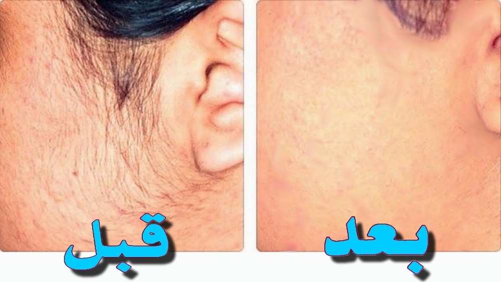 بدون ليزر.. وصفة سحرية لإزالة الشعر الزائد من الوجه والجسم كله وتبيض فوري للمناطق الغامقة