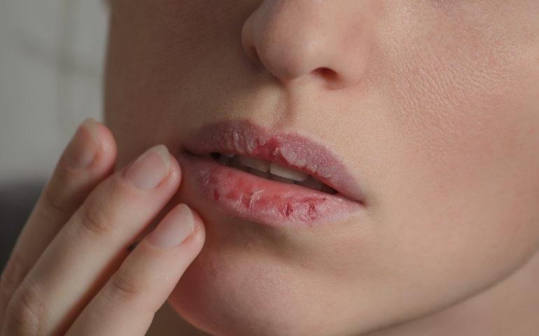 احذر.. ظهور علامات على شفتيك قد تكون إشارة لمشاكل صحية
