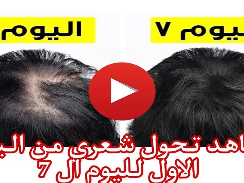 حل مشكلة سقوط الشعر عند الرجال والسيدات نهائيًا والنتيجة مدهشة بعد مرور 7 يوم