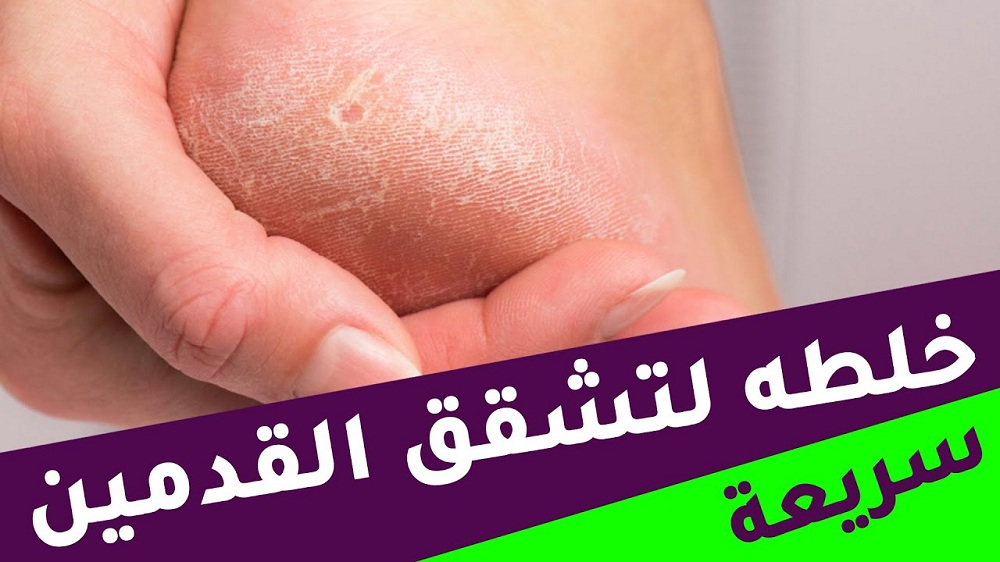 وصفة سحرية لتنعيم القدمين وإزالة الجلد الميت في الكعبين في المنزل!!
