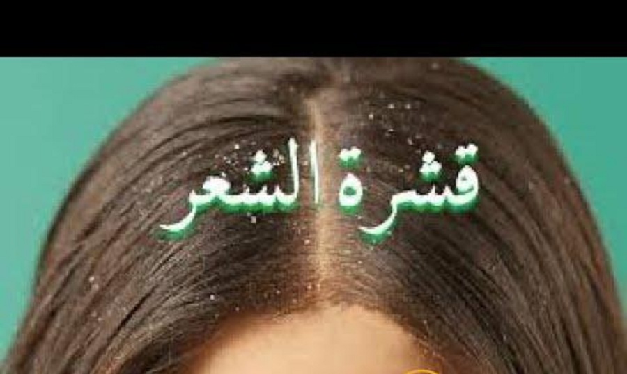 وداعا لقشرة الرأس.. وصفات طبيعية لعلاج قشرة الشعر هتتخلصي منها نهائياً في يومين فقط